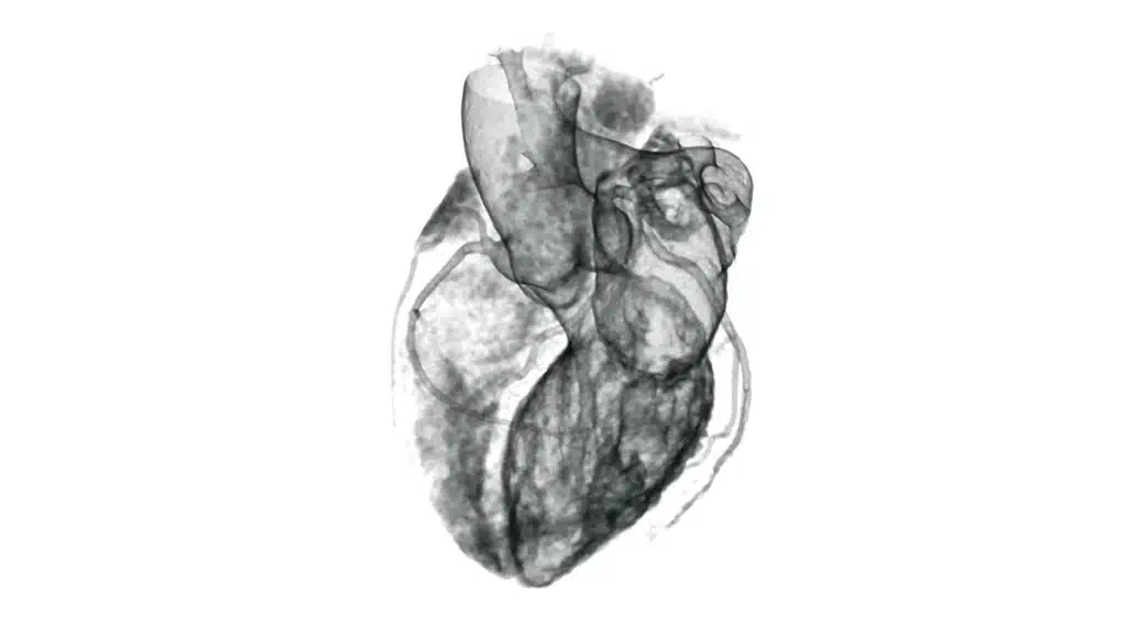 CT Heart Scan