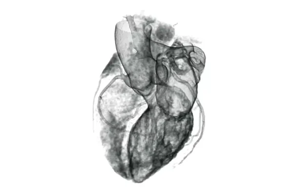 CT Heart Scan